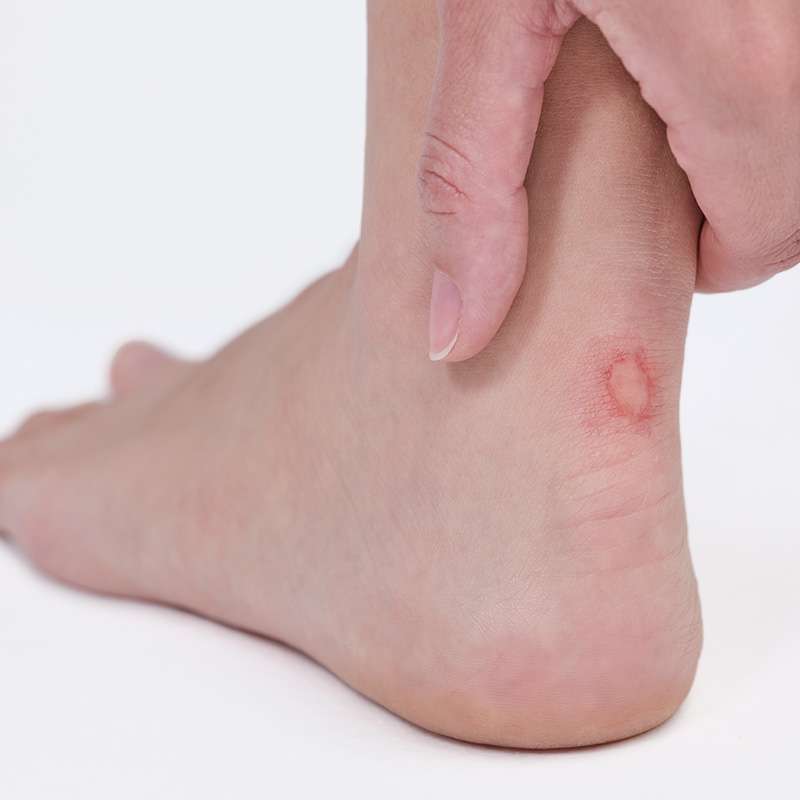 Blister on heel